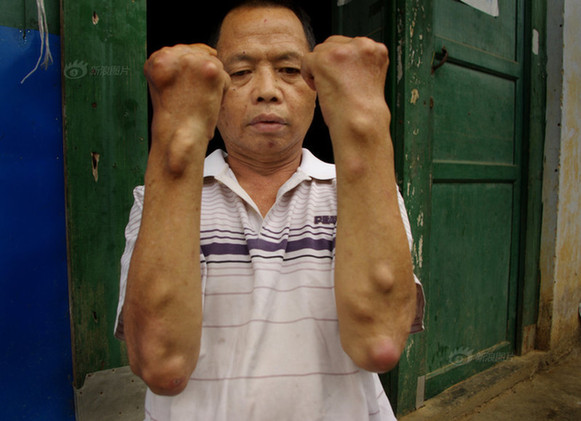 广西村庄遭重金属污染数年 村民手脚畸形