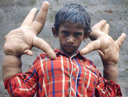 印度8岁小男孩患巨指症
