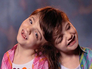 加拿大7歲連體姐妹共用大腦