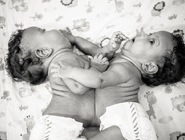 巴西共用腹部連體女嬰等待分離術